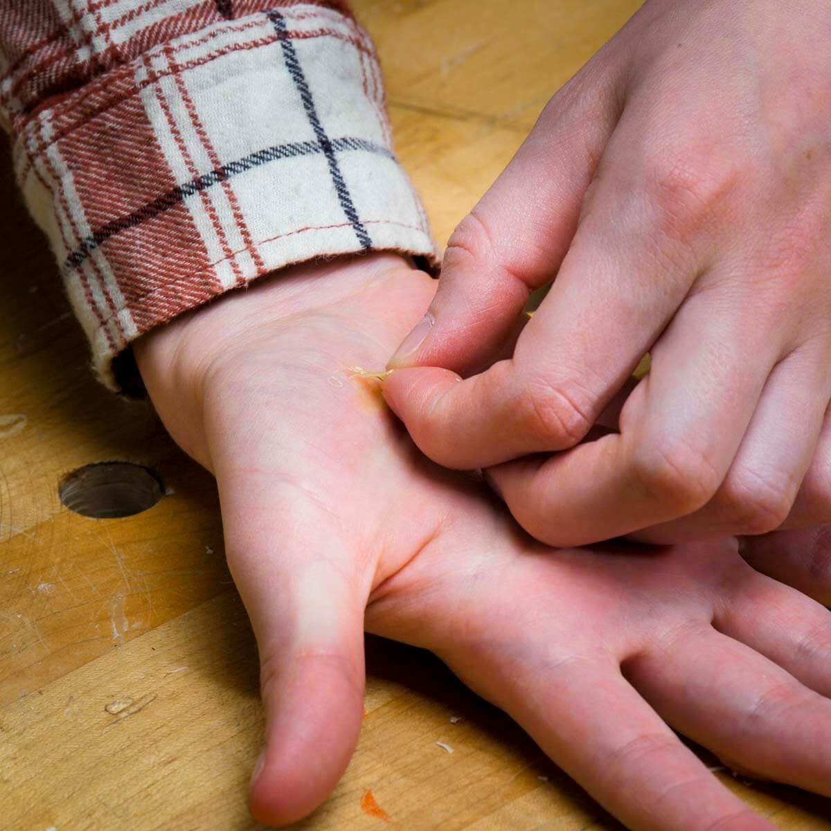 Removing a splinter